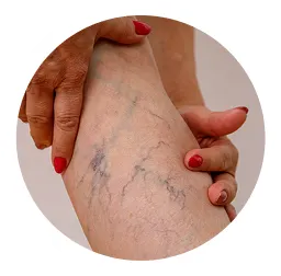 Varicose Veins